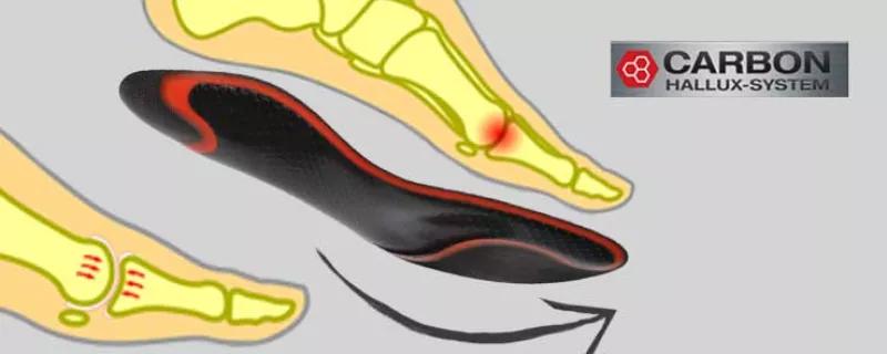 Kehitetty isovarpaan nivelrikkoon/osteo isovarpaan nivelen nivelrikkoon Kehitetty isovarpaan nivelrikkoon/osteo isovarpaan nivelen nivelrikkoon