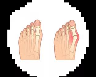 Hallux valgus jalka Hallux valgus jalka